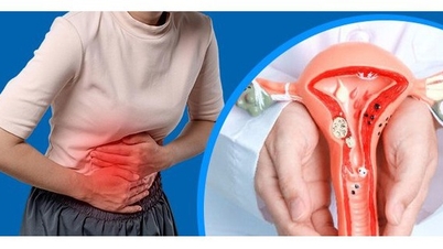 7 běžných příznaků endometriózy, kterým by ženy měly věnovat pozornost.
