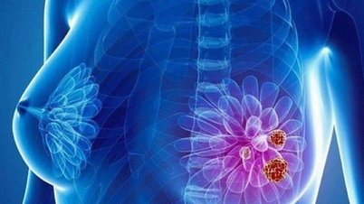 La donna ha scoperto di avere un cancro al seno a causa di un sintomo inaspettato.