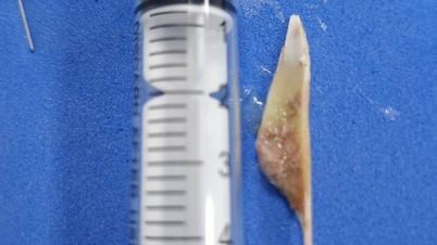 Un frammento osseo di lunghezza superiore a 3,5 cm è incastrato nell'esofago; i medici avvertono del pericolo.