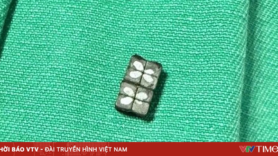Otto magneti sono stati rimossi con successo dallo stomaco di un bambino.