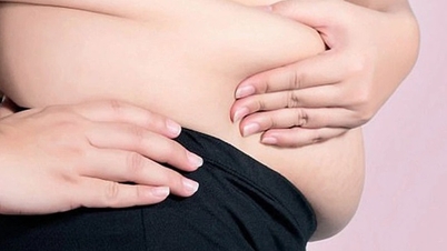 38세 여성이 자신의 부주의로 인해 여러 장기를 압박하는 거대 난소 낭종을 발견했습니다.