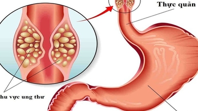 Zdravý muž, u kterého byla diagnostikována rakovina jícnu, přiznává dvě chyby, kterých se dopouští mnoho vietnamských mužů.