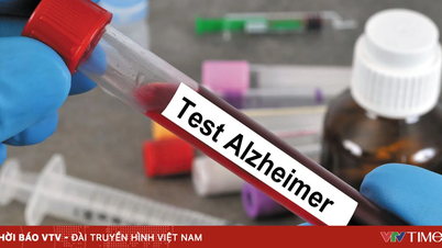 USA utvecklar ett blodprov som kan hjälpa till att upptäcka Alzheimers sjukdom tidigt.