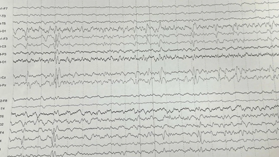 Padaczka po udarze mózgu – niebezpieczne powikłanie neurologiczne, które często jest bagatelizowane.