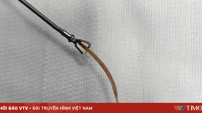 Tăm tre đâm thủng đại tràng sau bữa ăn