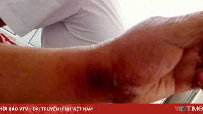 Uyarı: Zehirli böceklerle temas halinde enfeksiyon ve ciddi zehirlenme riski vardır.