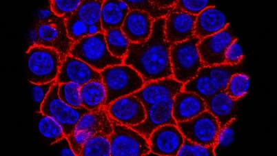 Medicația orală experimentală oferă noi speranțe în tratamentul cancerului pancreatic.