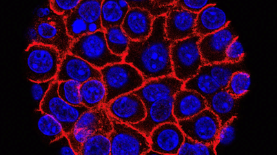 Unas píldoras experimentales ofrecen nuevas esperanzas en el tratamiento del cáncer de páncreas agresivo.