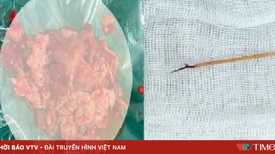 حالة نادرة: عود أسنان من الخيزران يخترق قلب طفل، مما يتسبب في تراكم القيح بشكل خطير.