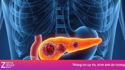 अग्नाशय कैंसर के 4 सूक्ष्म प्रारंभिक चेतावनी संकेत