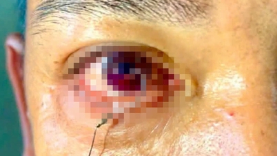 Notfallbehandlung eines Patienten mit einem im Auge steckenden Angelhaken.