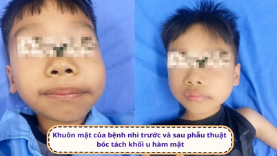Kejayaan membuang tumor besar yang memusnahkan tulang rahang seorang budak lelaki berusia 7 tahun.