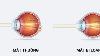 Copiii cu astigmatism trebuie să poarte ochelari?