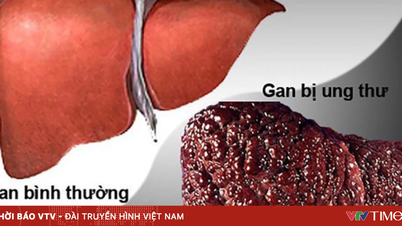 Apa yang harus dilakukan oleh orang-orang yang berisiko tinggi terkena kanker hati?
