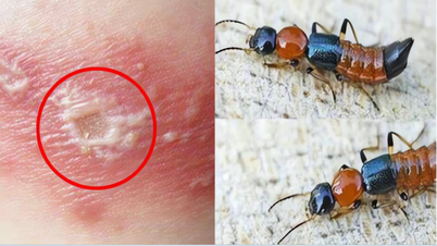 Paederus beetle attack: Doctor advises on the best way to minimize skin damage.