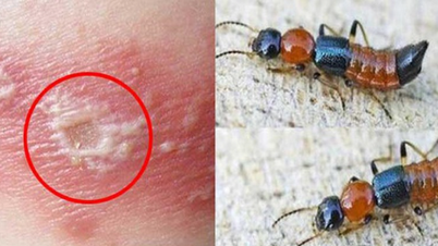 Doctors explain how to differentiate between dermatitis caused by blister beetles and shingles.