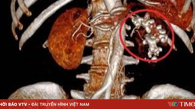 Jangan gunakan ubat herba untuk merawat batu karang.