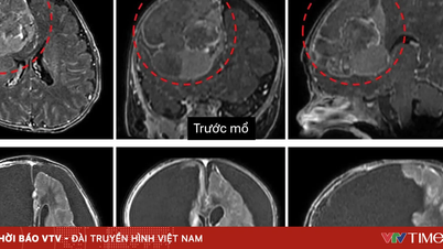 Pengangkatan tumor otak ganas dari bayi berusia 2 bulan.