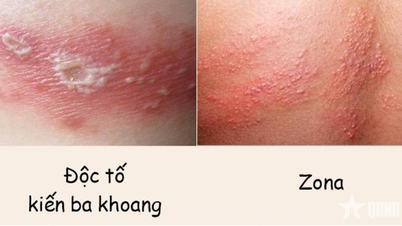 Distinguishing between blister beetle bites and shingles