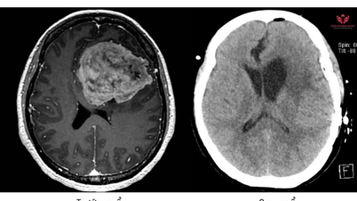 Esquecida e quieta, a mulher descobriu que tinha um grande tumor cerebral.