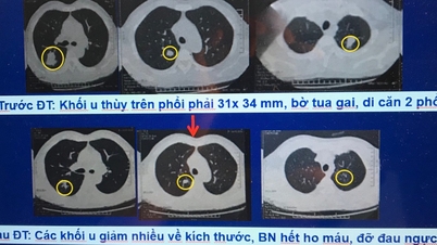 Bach Mai Hospital behandler effektivt metastatisk kræft ved hjælp af en ny metode.