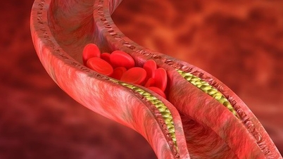 Mudanças no estilo de vida podem ajudar a controlar o colesterol alto e reduzir o risco de doenças cardiovasculares.