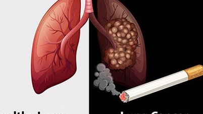 Le tabac est responsable de 90 % des cas de cancer du poumon.