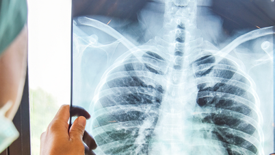 Moving closer to the goal of preventing lung cancer early.