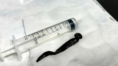 Pihak berwenang mengeluarkan lintah sepanjang lebih dari 12 cm yang hidup di saluran pernapasan seorang gadis berusia 8 tahun.