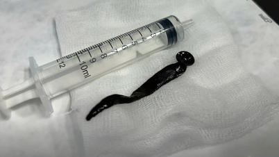 Pihak berwenang mengeluarkan lintah sepanjang lebih dari 12 cm dari saluran pernapasan seorang pasien berusia 8 tahun.