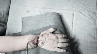 Saving the severed hand of a 22-month-old child caused by a cup-making machine.