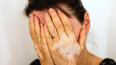 Pigmentasi boleh dipulihkan kepada 70-100% jika vitiligo dikesan lebih awal.
