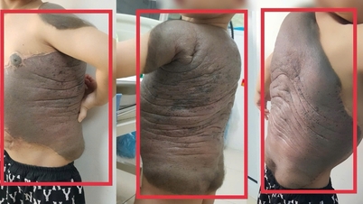 Menino com tumor gigante em formato de "casco de tartaruga" fica em pé pela primeira vez em 7 anos.