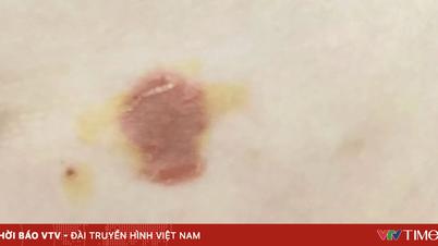 Waspadai impetigo pada anak-anak selama musim panas.