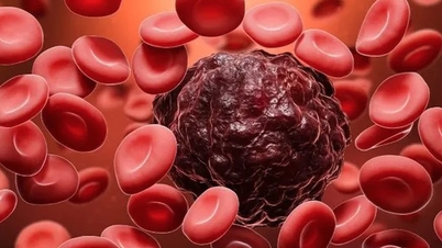 Após anos de tratamento para cirrose, os médicos descobriram que a verdadeira causa era uma forma rara de câncer no sangue.