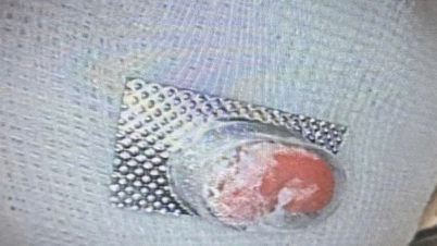 Seorang bocah berusia 12 tahun hampir mengalami perforasi kerongkongan setelah menelan pil yang masih berada dalam kemasan blister dengan tepi yang tajam.