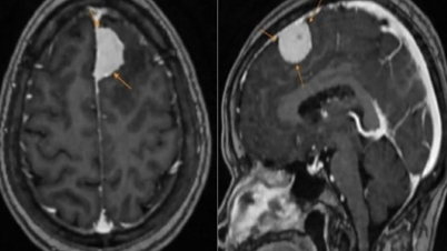 Karena mengira insomnia yang dialaminya disebabkan oleh usia, wanita itu menemukan meningioma saat melakukan pemeriksaan kesehatan.