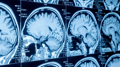 Terobosan dalam diagnosis kanker menggunakan pencitraan resonansi magnetik.