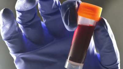Überraschenderweise haben manche Blutgruppen ein höheres Risiko, an Diabetes zu erkranken als andere.