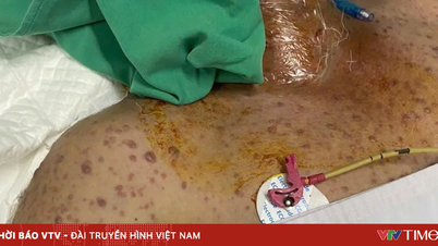 آبله مرغان در صورت بروز عوارض شدید می‌تواند تهدیدکننده زندگی باشد.