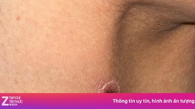 Một vết đốt khô, không đau khiến người phụ nữ lâm bạo bệnh