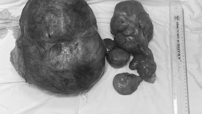 Setelah menggunakan pengobatan tradisional Vietnam selama 6 bulan, tumor perut tersebut tumbuh hingga hampir 8 kg.