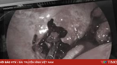 Caso extremamente raro de "gravidez gemelar" descoberto em mulher grávida de 28 anos.