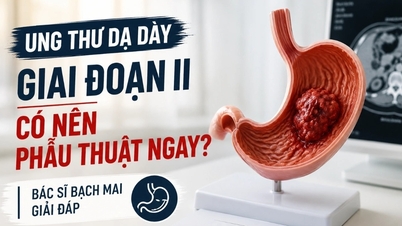 Kemoterápiával kell kezelni a II. stádiumú gyomorrákot?