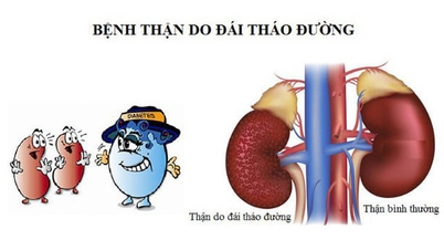 Medicamentos SGLT2i - Uma nova descoberta na proteção renal para pessoas com diabetes.
