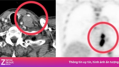 Zdiagnozowano u mnie dwa rodzaje raka jednocześnie z powodu dwóch nawyków, które wykształciłem przez wiele lat.