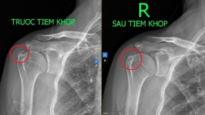 Un dolor sordo y persistente en el hombro es un signo de tendinitis calcificada.