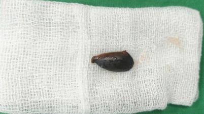 Nadat ik een jaar lang had gehoest, was ik verrast toen er tijdens een controle een sapodillazaadje in mijn bronchiën werd aangetroffen.