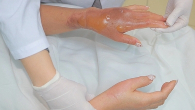 Bỏng nặng vì bột thông bồn cầu, chuyên gia chỉ nguyên nhân