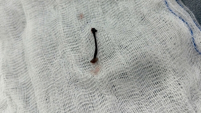개울에서 목욕하던 30개월 된 남자아이의 코에 거머리가 들어갔다.